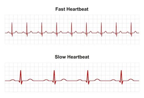 rapid or irregular beating of the heart figgerits|Heart palpitations .